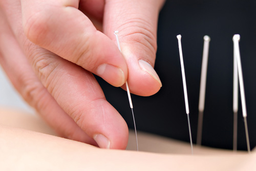 Acupuncture may ease cancer-related fatigue
