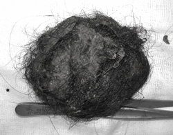 200g hair bun in 5-year-old child's stomach
