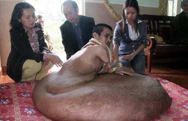 Da Lat: Young man carries 80kg tumor for ten years