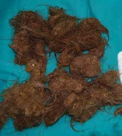 0.5kg of hairs taken from little girl&rsquo;s stomach